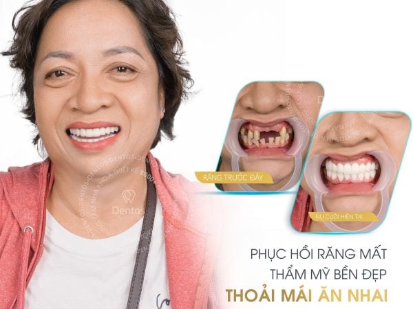 Sau khi cấy ghép implant, tình trạng khó chịu và đau đớn thường kéo dài không quá lâu